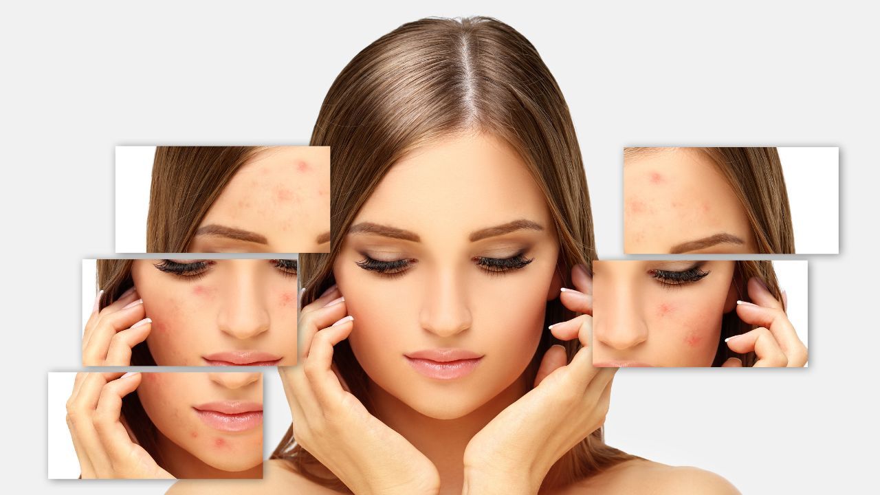 Top Primers for Acne Prone Skin That Won't Break the Bank