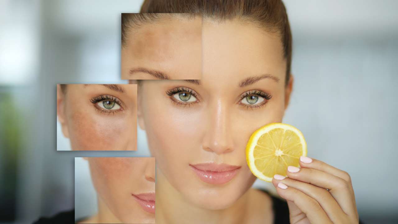 Vitamin C Hyperpigmentation Treatments That Actually Work