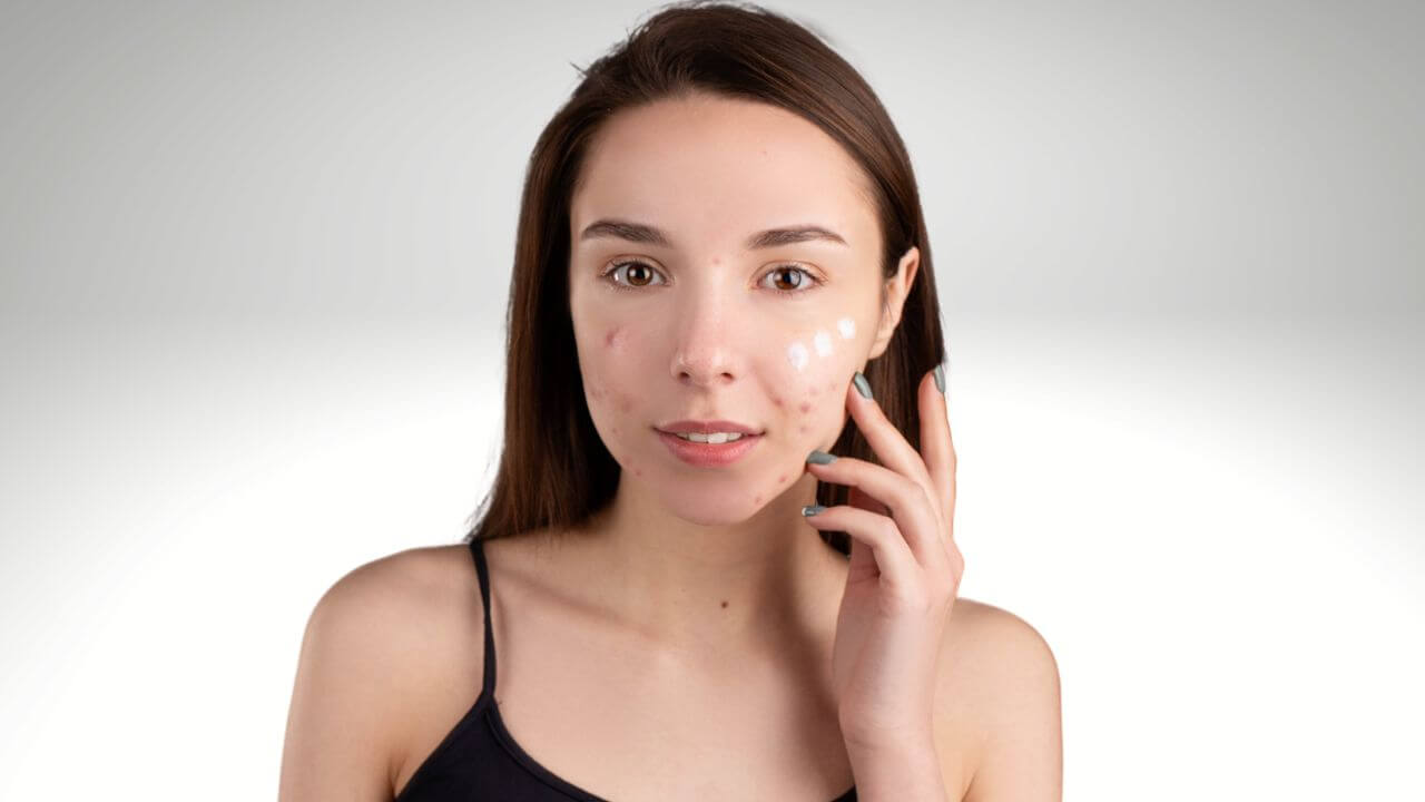 Closeup of a young woman concealing 3 of many acne blemishes on her left cheek with foundation on a light gray background.