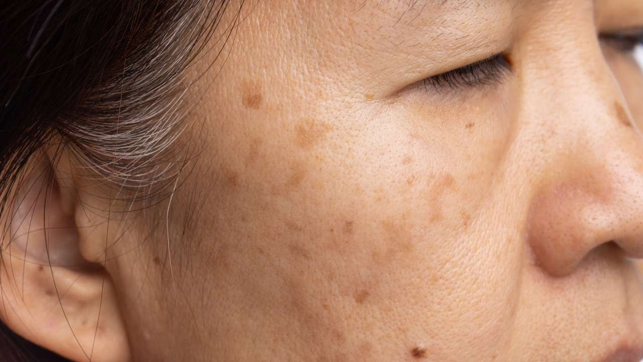 Vitamin C Hyperpigmentation Treatments That Actually Work